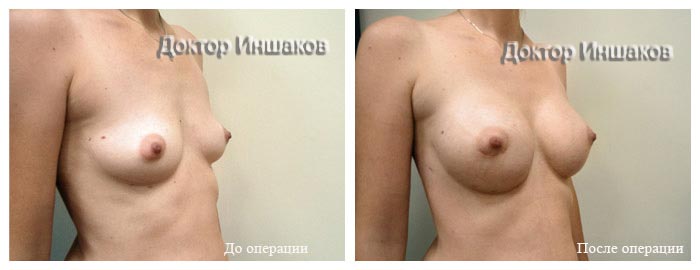 Маммопластика доктор Иншаков