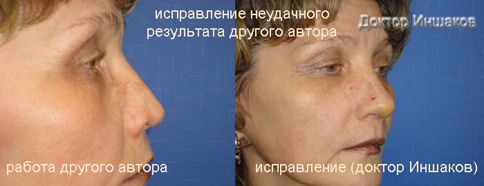 Исправление ринопластики другого хирурга сбоку