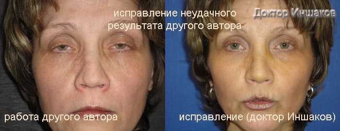 Исправление ринопластики другого хирурга спереди