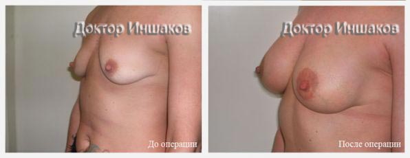 коррекция размера - пластика груди