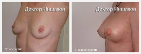 коррекция размера - подтяжка груди