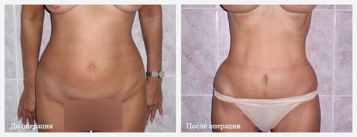 Мини абдоминопластика