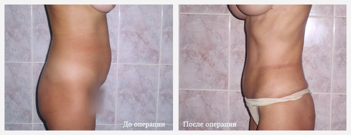 процедура абдоминопластики