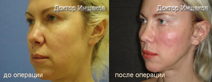 Блефаропластика нитями силуэт лифт