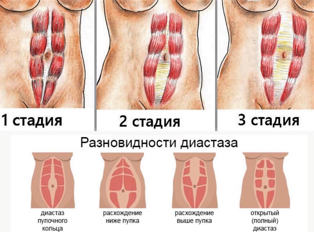 Диастаз