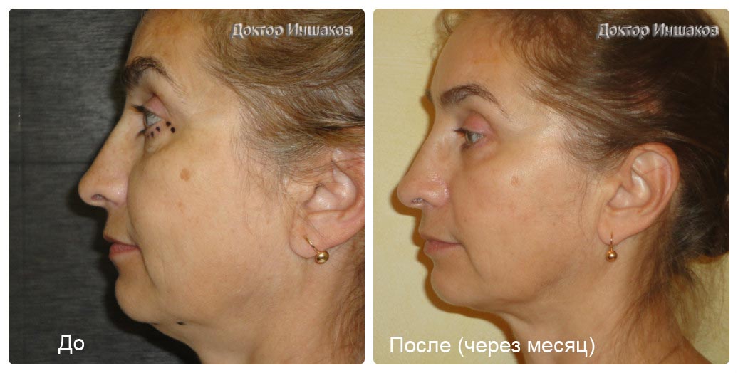 новые технологии омоложения лица