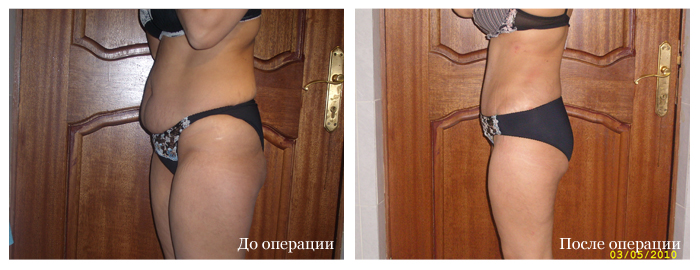 абдоминопластика