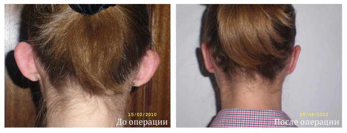 otoplastica