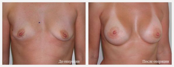 безопасное увеличение груди