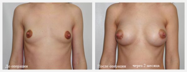 операция по пластике груди