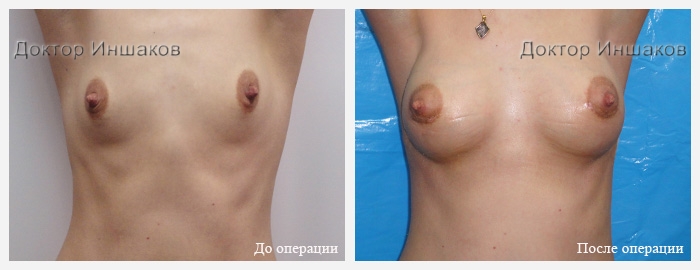увеличение груди