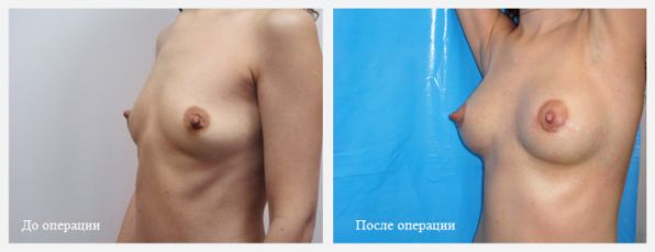 операция подтяжки груди