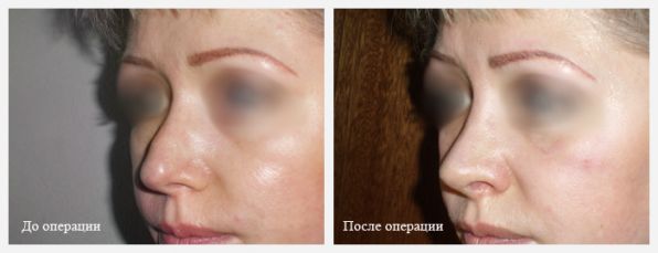 операция по ринопластике