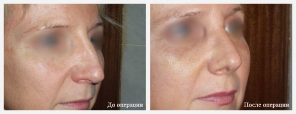 результат ринопластики