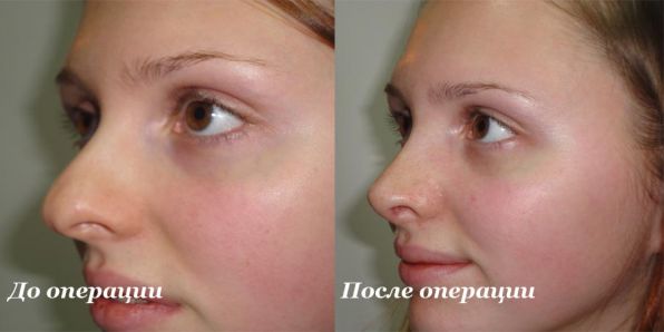 Уменьшение кончика носа